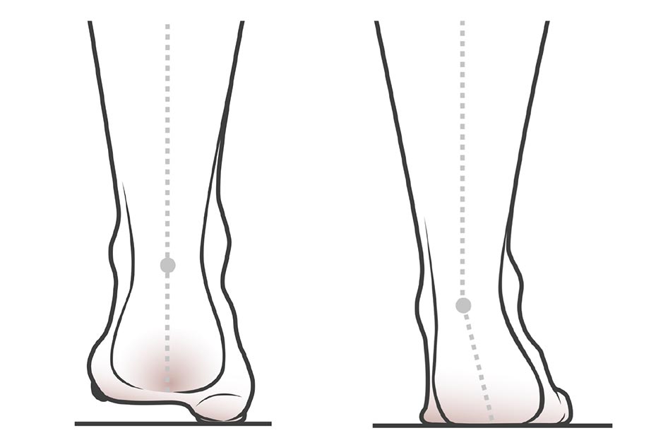 Mikä on kaarijalka ja mihin se voi altistaa?